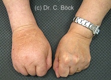 CRPS I . Morbus Sudeck